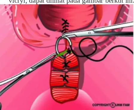 Gambar. Penjahitan otot bulbokavernosus dengan cara terputusSumber: Leeman et al, (2003)