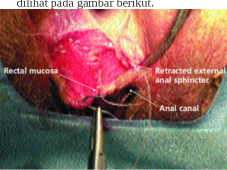 Gambar. Mukosa rektal dan Spincter anus eksternal