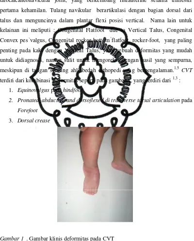 Gambar 1  . Gambar klinis deformitas pada CVT  