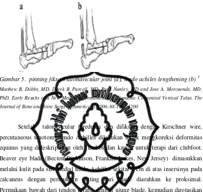 Gambar 5.  pinning fiksasi talonavicular joint (a), tendo achiles lengthening (b) 3 