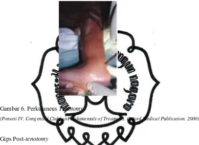 Gambar 6. Perkutaneus Tenotomy 