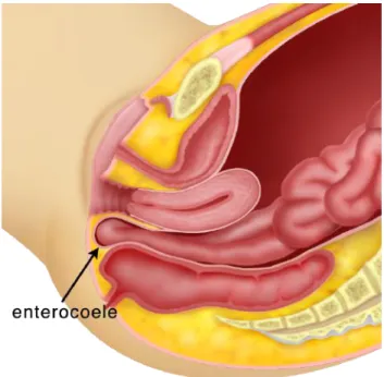 Gambar 10.3 Enterokel