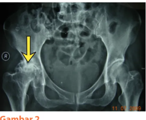 Gambar 1a. Tulang rawan bonggol tulang paha normal. Gambar 1b. Tulang rawan bonggol tulang paha telah aus.