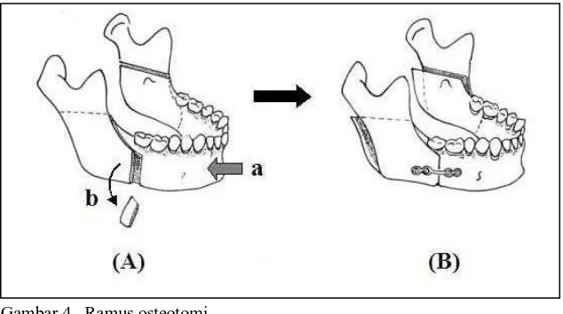 Gambar 4.  Ramus osteotomi          occlusal reconstruction of old malunited jaw fracture
