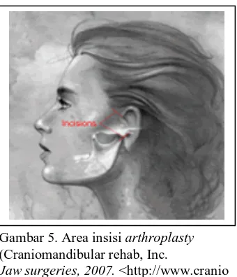 Gambar 5. Area insisi arthroplasty (Craniomandibular rehab, Inc. 