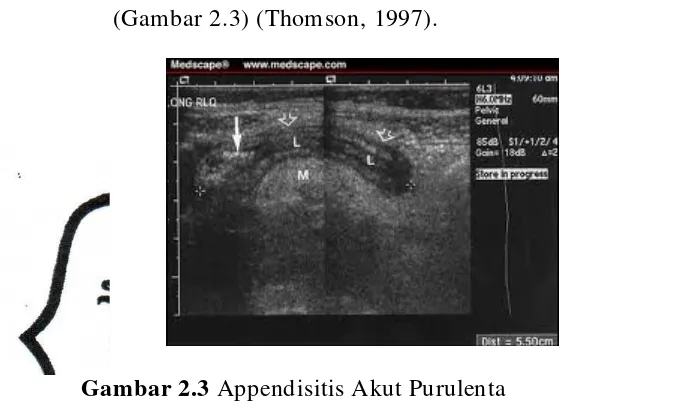 Gambar 2.3 Appendisitis Akut Purulenta 