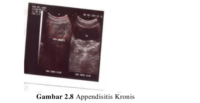 Gambar 2.8 Appendisitis Kronis 