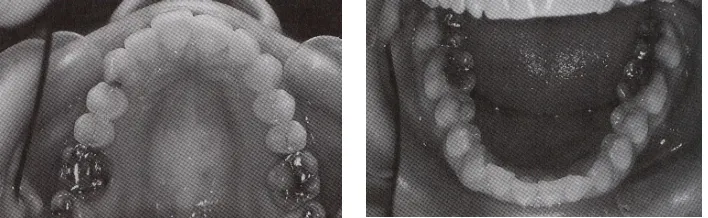 Gambar 1:  Contoh kasus gigi berjejal ringan pada rahang atas dan rahang bawah                     dapat dirawat dengan  alat ortodonti sederhana 