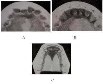 Gambar 2:  A. Kasus gigi berjejal anterior rahang bawah      