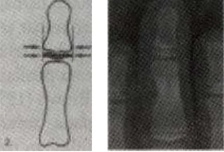 Gambar 3. Anatomi phalanx (Loh 1999) 