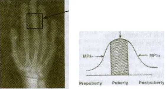 Gambar 6. Radiograf periapikal pada MP3 dan Diagram hubungan tingkat osifikasi epiphysial MP3 dengan pubertas