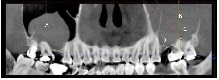 Figure 1. 3-� Radiographic of tooth 27. 
