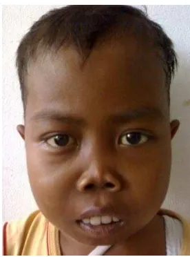 Gambar 2. Fasies Cooley 