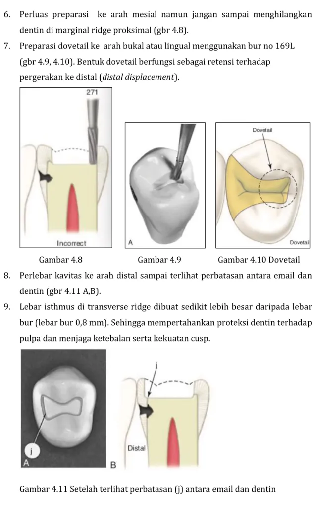 Gambar 4.11 Setelah terlihat perbatasan (j) antara email dan dentin 