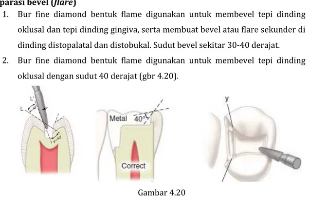 Gambar 4.21   Bevel  di axiopulpa (yang diberi warna ungu) 