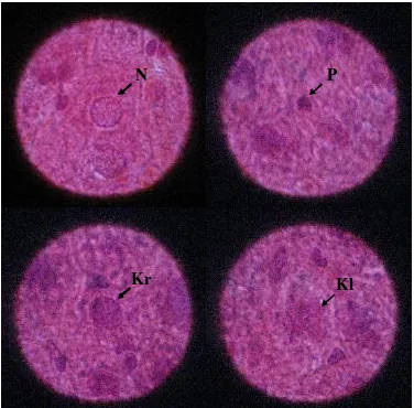 Gambar 4. Gambaran histologis sel hati normal dan yang mengalami kerusakan 