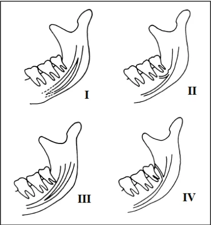Gambar 3. Klasifikasi tipe-tipe  bifid mandibular canal menurut Nortje.17 
