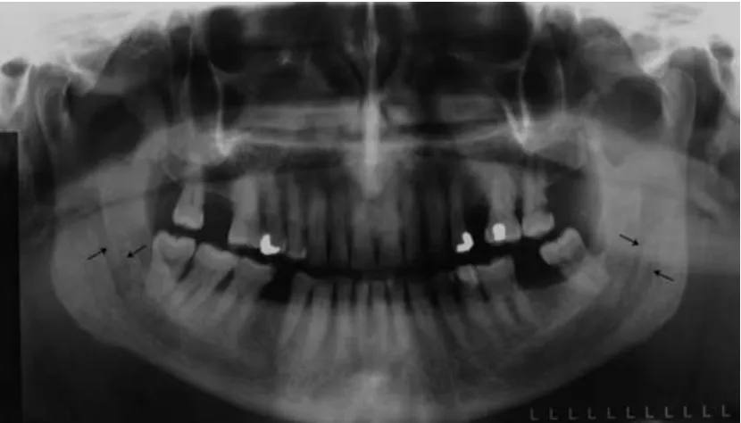 Gambar 4. Gambaran radiografi panoramik yang menunjukkan terdapat bifid mandibular canal pada kedua-dua sisi mandibula.9 