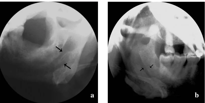 Gambar 5. A) Proyeksi mandibula oblique lateral kiri dimana terdapat dua kanal yang berasal dari dua foramen mandibular yang berbeda