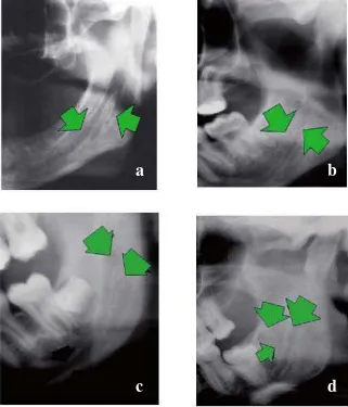 Gambar 6. Varisasi bentuk  bifid mandibular canal. A) Gambar radiografi bifid mandibular canal, tipe I