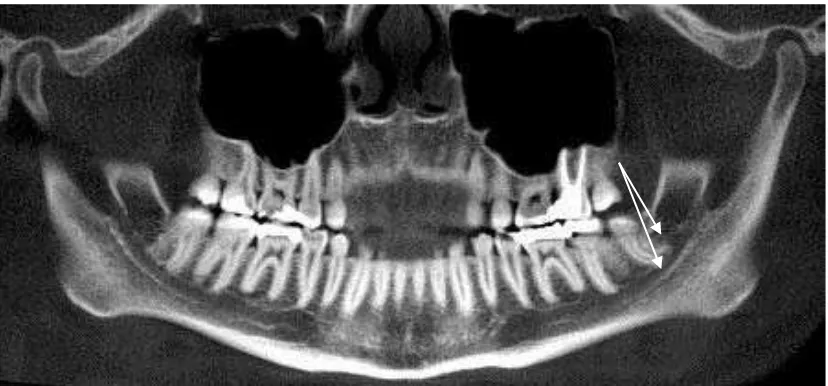 Gambar 7. Gambaran foto CT dari pandangan panoramic/aksial. Tanda anak panah putih menunjukkan  bifid mandibular canal pada mandibular kiri pasien dengan kanal supplemennya menuju ke retromolar pad.16 