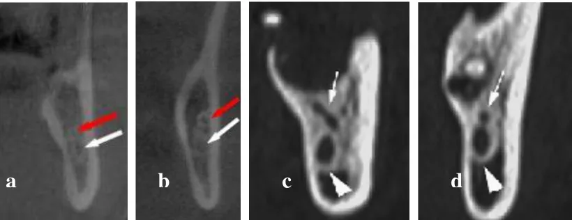 Gambar 8. Gambaran foto CT dari pandangan cross-sectional bifid mandibular canal pada seorang pasien pria berumur 54 tahun