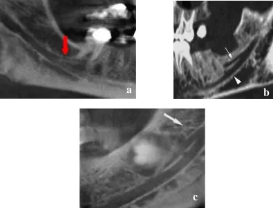 Gambar 10. Gambaran foto CT dari pandangan sagital  bifid mandibular canal dari beberapa pasien