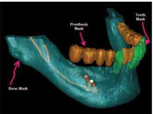 Gambar 13. A) Divisi pada bagian posterior mandibula dimana  bifid mandibular canalnya berasal dari dua foramen