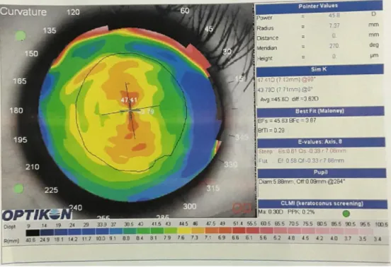 Gambar 2.1. Computerized corneal topography mata kanan Dikutip dari: RS Mata Cicendo