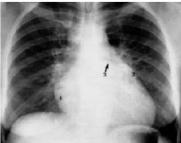 Gambar 11. Sinar X pada Alat Ronseng  Sinar Gamma  