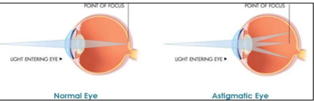 Gambar 2 . 2 .  Perbedaan Refraksi Mata Normal dan Astigmatisma 