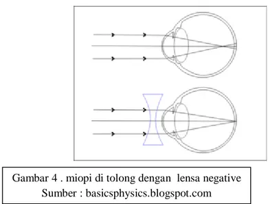 Gambar 4 . miopi di tolong dengan  lensa negative  Sumber : basicsphysics.blogspot.com 