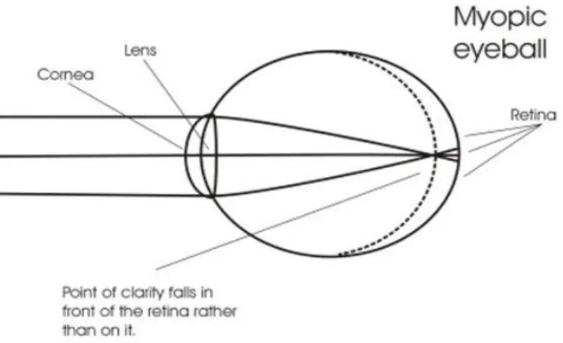 Gambar 2.1 Refraksi pada miopia aksial, dimana bayangan jatuh di depan retina   akibat panjang sumbu bola mata yang terlalu panjang (Anonym, 2010) 