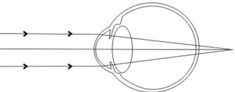 Gambar 2.2 Refraksi pada mata yang mengalami hipermetropia, dimana bayangan  jatuh di depan belakang retina (Anonym, 2010) 