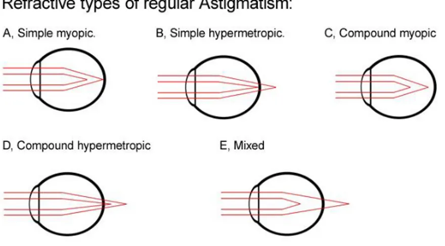 Gambar 2.3 Tipe-tipe refraksi pada astigmatisma reguler yang disebabkan karena  adanya dua garis fokus terhadap retina (Anonym, 2010) 