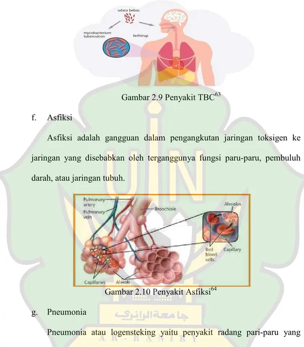 Gambar 2.9 Penyakit TBC 63 f.  Asfiksi 
