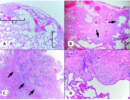 Figure 1. Histopathologic features of pneumothorax-associated fibroblastic lesion (PAFL).
