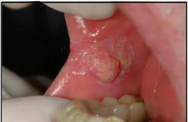 Gambar 6: Kanker rongga mulut.28 