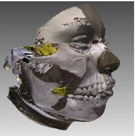 Figure 4. The variation of gravity test with marks. The little migration over the zygomatic arch is present