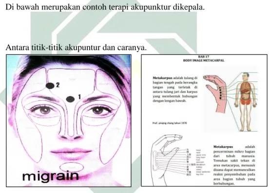 Foto ini menunjukkan antara titik  titk akupunktur untuk migrain 