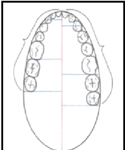 Gambar 7. Bentuk lengkung gigi Brader (Jain &amp; Dhakar, 2013). 