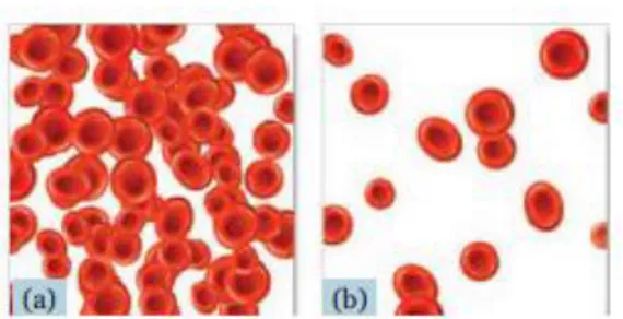 Gambar 2.9 Perbandingan sel darah merah dalam kondisi  normal dan penderita anemia 
