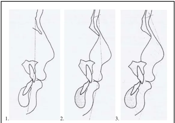 Gambar 5.   Analisa konveksitas wajah menurut Subtelny. (1) Sudut Konveksitas         wajah skeletal (N-A-Pog)