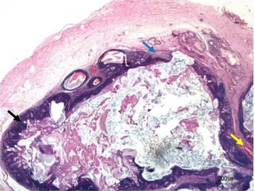 Gambar 2. Nodul kista tumor yang ditemukan pada daerah dermis kulit. Sel epitel basaloid dinding kista yang bertransisi menjadi epitel squamousa (panah hitam), serta jaringan stroma myxoid (panah biru) dan  mikrohemoragi (panah kuning) ditemukan pada daera