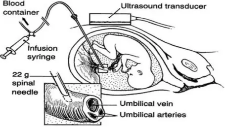 Gambar 2.8 Transfusi Intrauterina