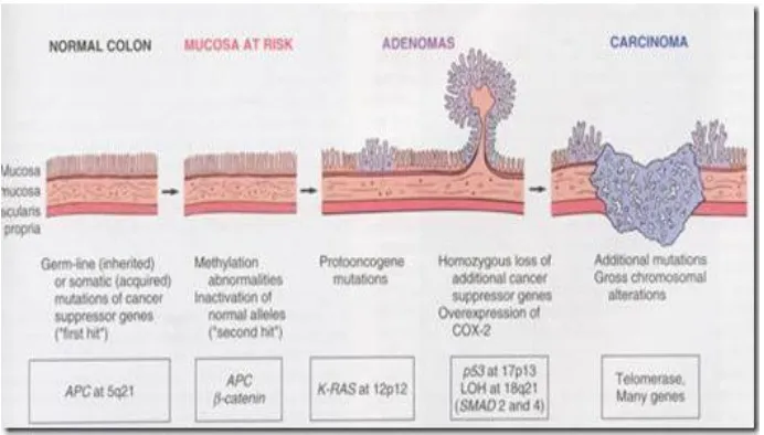 Gambar 4.Rangkaian adenoma-karsinoma. Perkembangan karsinoma dari lesi adenomatosa disebut sebagai rangkaian adenoma-karsinoma