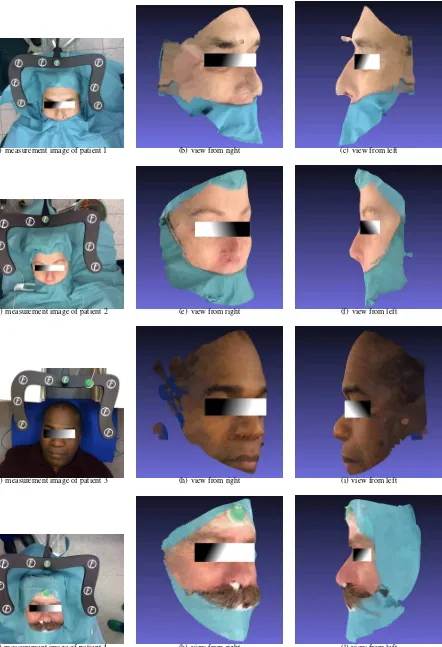 Figure 7: 3D reconstructions of patient faces.
