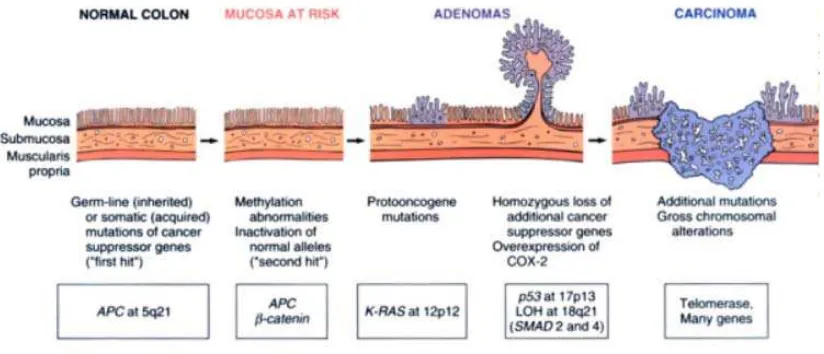 Gambar 2.6   Skema perubahan morfologi dan molecular dalam adenokarsinoma. Ditunjukkan bahwa kehilangan dari gen penekan tumor (APC) terjadi pada awal kejadian (Robbins Basic Pathology, 7th ed) 