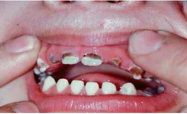 Gambar 1. Nursing caries yang mengenai keempat gigi insisivus rahang atas (tipe 2) 