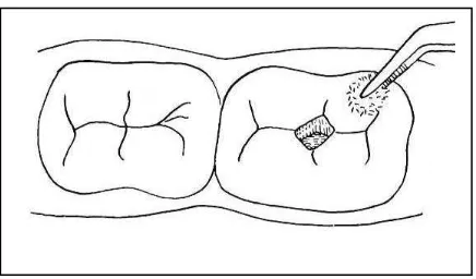 Gambar 9. Pengaplikasian dentin kondisioner 26  